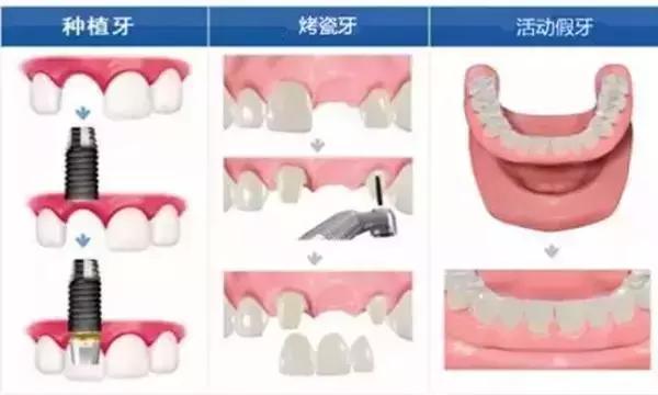 种植牙 VS 镶牙，哪个更胜一筹？