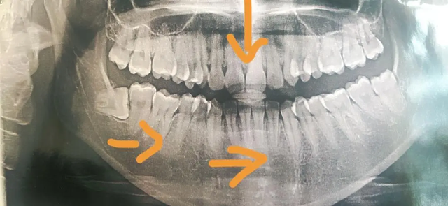 牙齿变歪是什么原因造成的？专家：多半是这些原因引起的