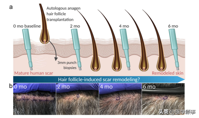 真正改善疤痕，最简单的可能是移植毛囊？