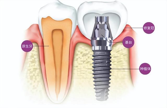 “暴利”的种植牙：成本几百售价上万？如今纳入医保，或降价90%