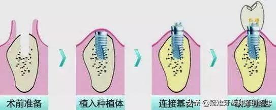 「科普」如果想做种植牙，现在开始要准备些什么？