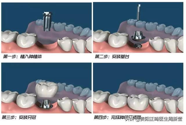 为什么镶完假牙老是牙疼，是什么原因导致？