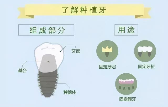 关于种植牙，你最想了解的几个问题#雅悦齿科#