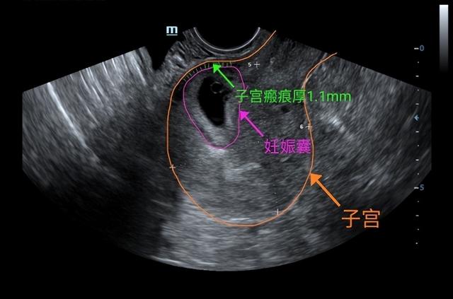 瘢痕妊娠风险大 海扶治疗解难题