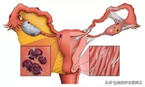 子宫内膜异位症