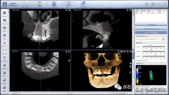 行研｜数字化口腔导航新科技，种植牙市场腾飞正当时