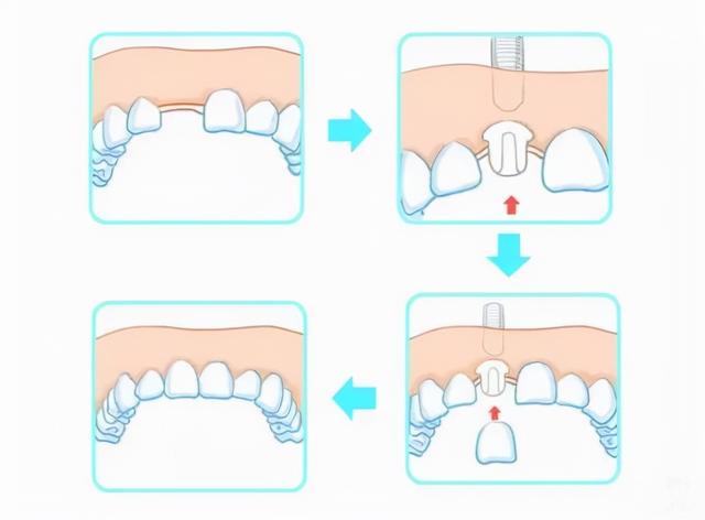 「牙齿那些事儿」No.80丨拔牙后是即刻种植，还是3个月后再种植牙