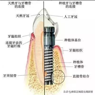 为什么镶完假牙老是牙疼，是什么原因导致？