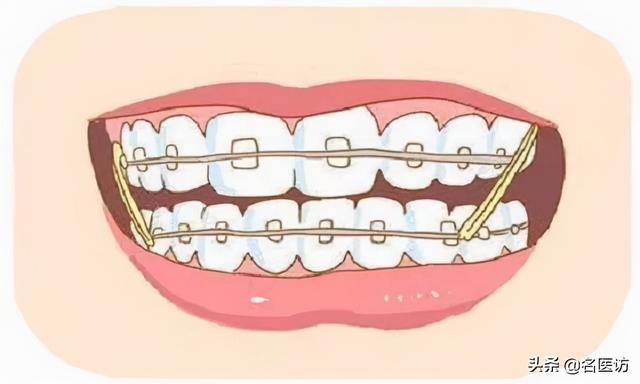 正畸医生让你打骨钉？不用怕，这可是矫正利器