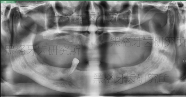 老爸60岁了还能种牙吗？上了年纪怎样减少种牙风险？医生解读