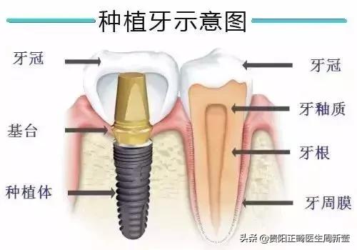 为什么镶完假牙老是牙疼，是什么原因导致？