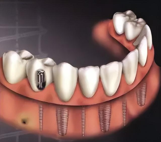 种植牙好处多，但不是人人都可以做，到底是为什么？
