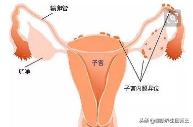 子宫内膜异位症