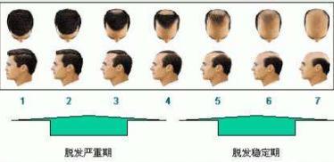 毛发移植不贵，你在逗我？