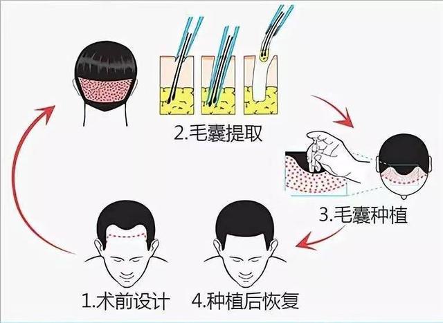 植发有风险，“脱”的很“秃”然，这届年轻人要钱还是要头发？