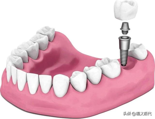 想种植牙齿的一定要等几天，保证让你省下六千元，全国各地都降价
