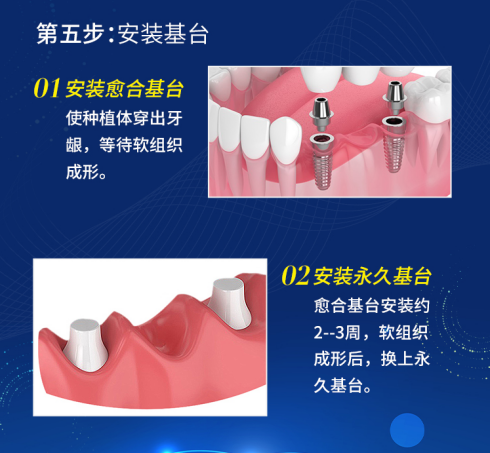 揭秘！大部分缺牙老人不知道的——种植牙全过程