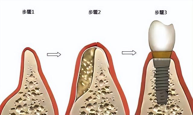 为什么种植医生在种牙前会告知需要先植骨粉？