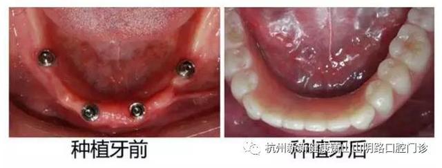 即刻种植牙修复 （全口、半口、多牙缺失解决方案）