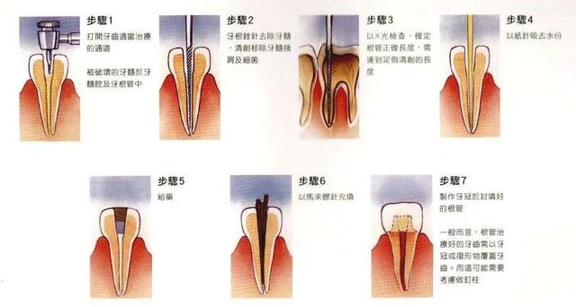 科普丨牙痛就拔牙？这真的不是最好的办法……