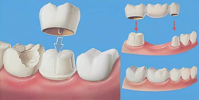 缺牙不治后患无穷！专家告诉你，种植牙、烤瓷牙到底该怎么选？