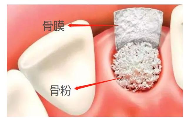 为什么种植医生在种牙前会告知需要先植骨粉？