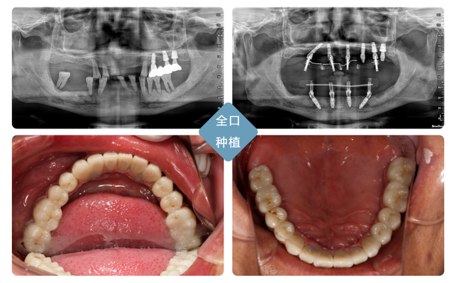 种植牙大合集！你想知道的都在这里
