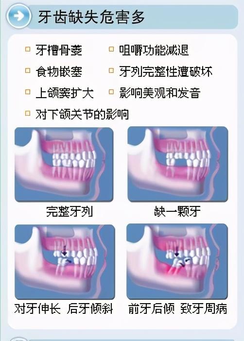 揭秘种植牙的“内幕”！是否传言所说，种牙像“拧螺丝钉”？