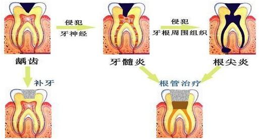 科普丨牙痛就拔牙？这真的不是最好的办法……