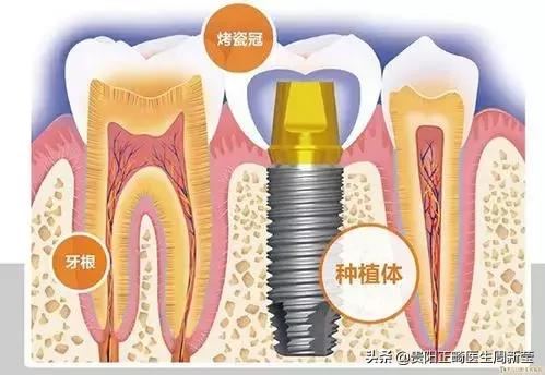 种植牙好在哪里？用真人案例告诉你