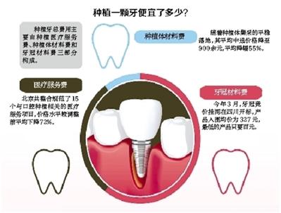 种植牙集采落地 掀起新一轮价格战