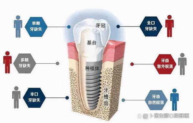 种植牙又贵又疼，我看谁还被骗