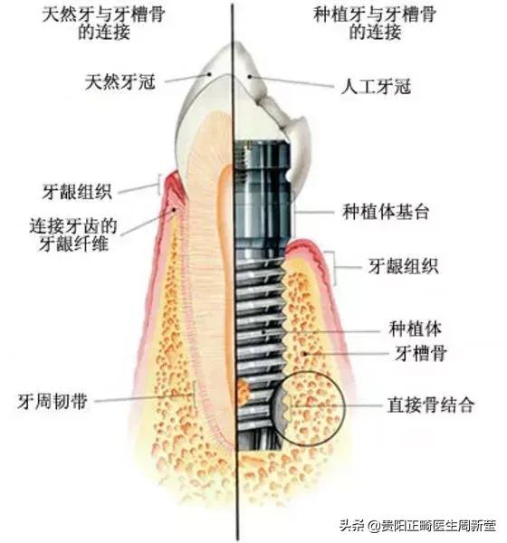 种植牙好在哪里？用真人案例告诉你