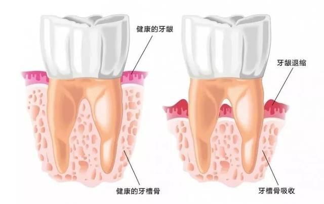 「牙齿那些事儿」No.25丨拔牙两年了，还可以做种植牙吗？