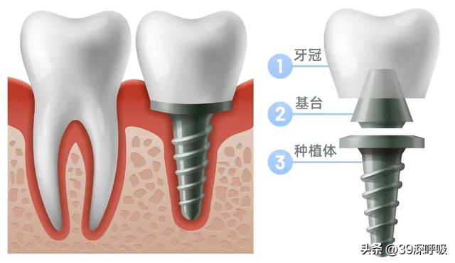 告别“万元时代”，中国人能种得起牙了吗？