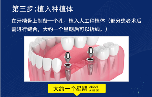 揭秘！大部分缺牙老人不知道的——种植牙全过程
