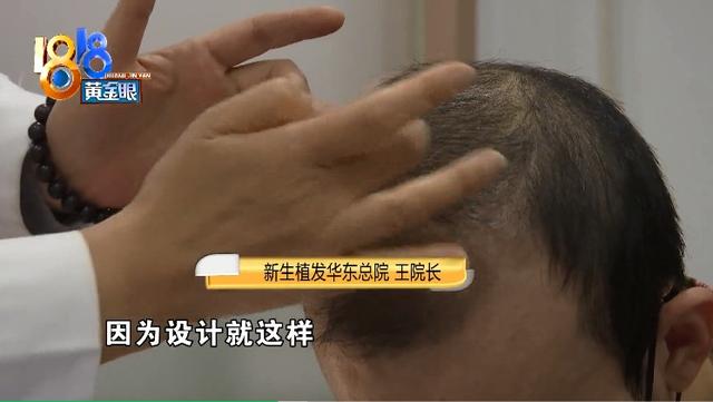 ​植发两年急转直下 质疑“拆东墙补西墙”