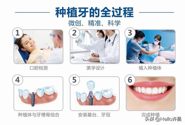 干货：种植牙，你不知道的冷知识