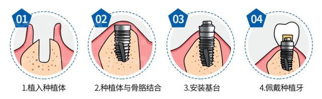 都说种植牙媲美真牙，那你知道它们之间有什么区别吗？