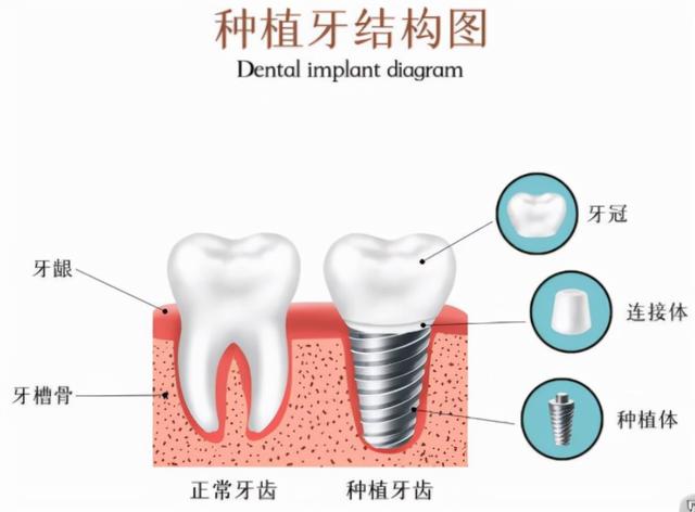 老年人种植牙后，种植体植入体内，身体会出现排异反应吗？