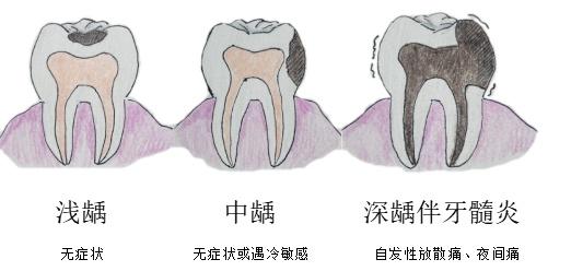 居家隔离，突发牙痛怎么办？口腔科医生“自救宝典”来了