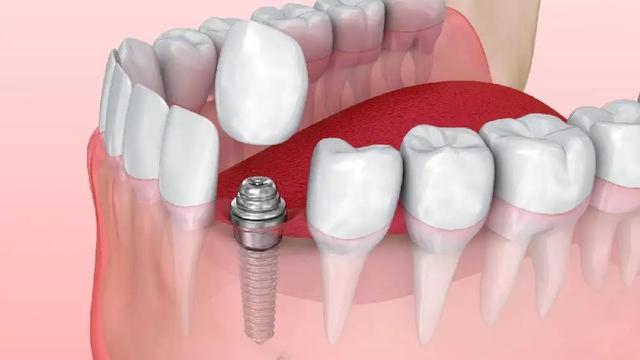 社区里也能种植牙啦！种牙安全吗？有哪些流程？