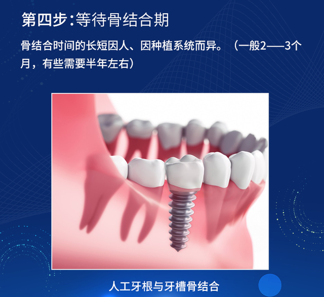 建议收藏！科普种植牙全过程