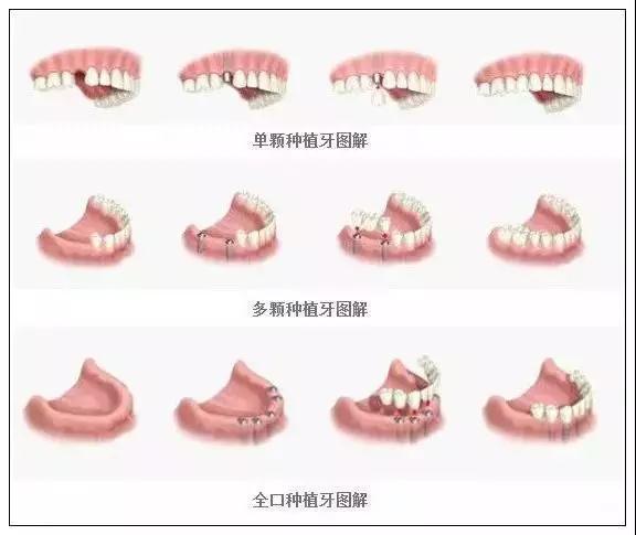 种植牙只有会保养，才会用得更久