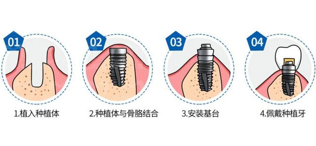 第一次种牙，你一定要知道的几个关键问题！