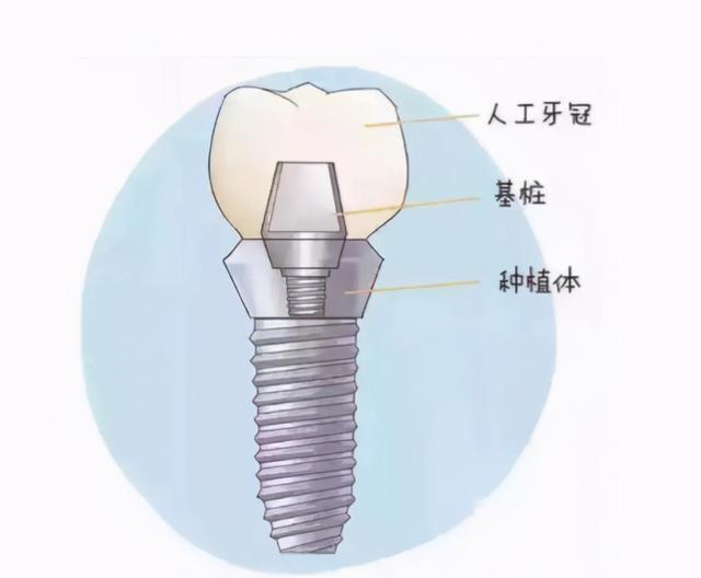 做完种植牙，要学会这5个保养方法！否则白种