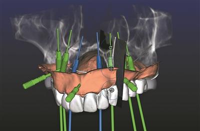 少花钱 不折腾 四颗种植体修复半口牙