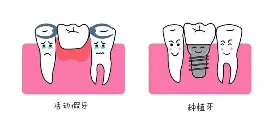 种植牙 VS 镶牙，哪个更胜一筹？