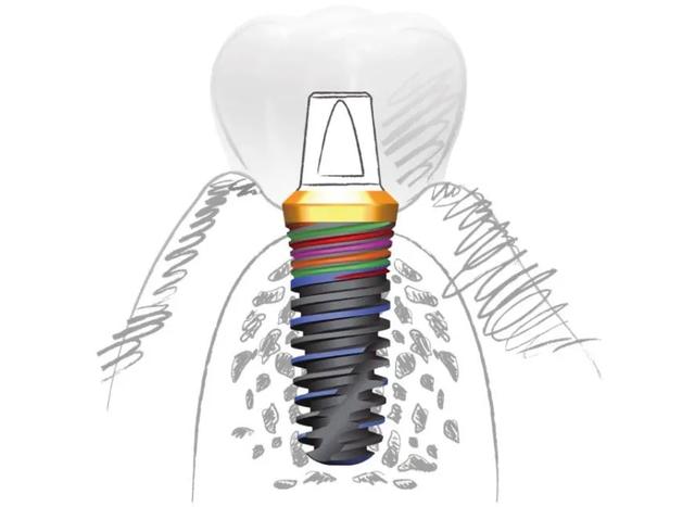 疫情期间，常被问到的种植牙小知识