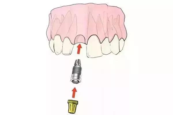 种植牙 VS 镶牙，哪个更胜一筹？